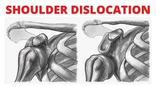 Shoulder Dislocation  Treatment of Dislocation [upl. by Ahtrim]