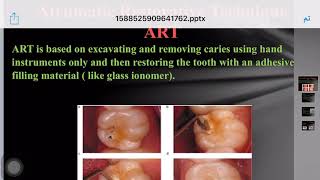 Atraumatic Restorative Treatment 5th stage [upl. by Isolda]