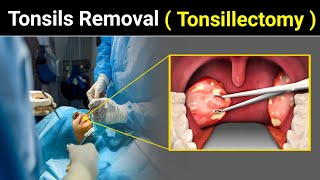 Tonsillectomy Procedure  How Tonsils Remove  Tonsils  Tonsillitis  3D ANIMATION UrduHindi [upl. by Cleodell]