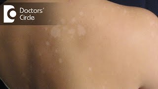 Managing round irregular skin patches not responding to topical creamsDr Rasya Dixit [upl. by Naylor]