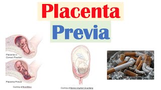 Placenta Previa Low Lying Placenta  Risk Factors Symptoms amp Complications Diagnosis Treatment [upl. by Narahs361]