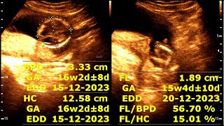 16 weeks 2 days pregnancy  Normal pregnancy [upl. by Fita]