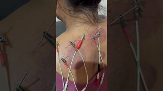 Frozon Sholder ampcervical pain treatment 🤓🧐shorts youtubeshorts acupuncture acupressure viral [upl. by Kiryt]