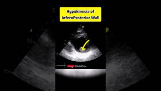 Hypokinetic InferoPosterior Wall anatomy heartphysiology heart echocardiagram [upl. by Fletch]