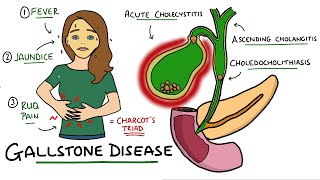 Gallstone Disease  Acute Cholecystitis vs Cholelithiasis vs Choledocholithiasis vs Cholangitis [upl. by Geldens]