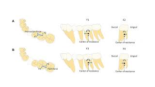 Molar Anchorage in Invisalign｜【Chris Chang Ortho】CC774 [upl. by Arac]