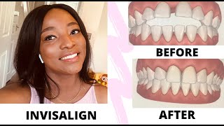 MY INVISALIGN REVIEW  BEFORE amp AFTER PICVIDEO COST PAIN AND PROGRESS LEVEL [upl. by Elana]