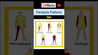 Paralysis or Weakness Patterns [upl. by Wilone]