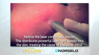 Melasma Dual Yellow laser treatment [upl. by Nire486]