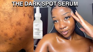 HOW TO GET RID OF DARK SPOTS WITH ONE PRODUCT  The ordinary [upl. by Irra]