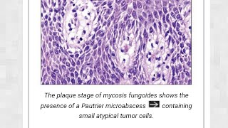 mycosis fungosis [upl. by Akcirre]