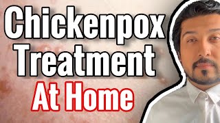 Chickenpox Treatment At Home 2020 [upl. by Gustave]