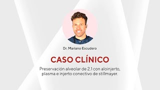 Caso Preservación alveolar de 21 con aloinjerto plasma e injerto conectivo  Dr Mariano Escudero [upl. by Rock]