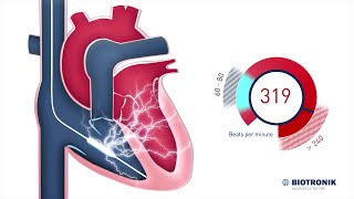 Implantable Cardioverter Defibrillator  How it works [upl. by Notnilk629]