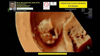 Hematom Subchorionic 89 weeks [upl. by Refinnaej]