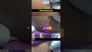 Safe and Effective Wart Removal Treatment [upl. by Elletse]