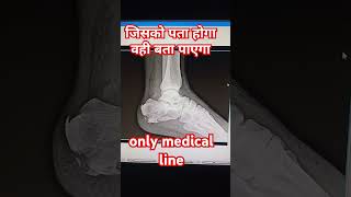 calcaneum fracture ankle joint xray doctor motivation anatomy medicalcareer [upl. by Anselme]