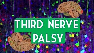 Third nerve palsy [upl. by Shing]