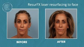 ResurFX minimal downtime laser resurfacing [upl. by Kitti]