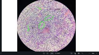 clear cell renal cell carcinoma [upl. by Wylde296]