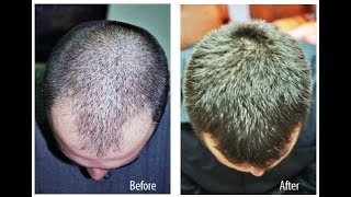 hair loss treatment for man 100 effective minoxidil 5 Mintop full reviews [upl. by Anihtyc454]