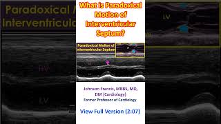 What is Paradoxical Motion of Interventricular Septum [upl. by Barta414]