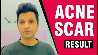 Testimonials Effective Treatments for Acne Scars Sakhiya Skin Clinic Patient Review [upl. by Elauqsap]