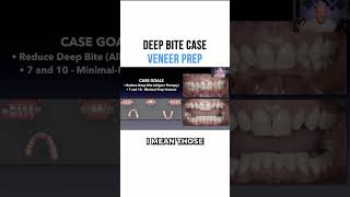 Deep Bite Case Veneer Prep [upl. by Elimay17]