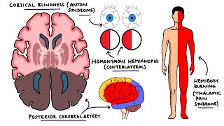 Posterior Cerebral Artery Stroke Syndromes  PCA Stroke Syndromes  Stroke Syndromes [upl. by Jordan]