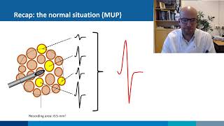 Needle EMG normal vs myopathic MUPs [upl. by Ailicec]