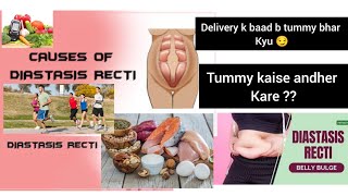 Diastasis Recti Delivery k baad b tummy bhar hai kyu janiye viralvideo medical knowledge [upl. by Ludwog]