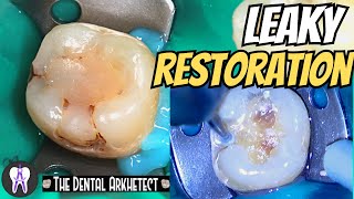 Replacing an Old Restoration While Preventing Recurrent Caries C43 4k [upl. by Bruce]