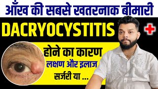 Chronic Dacryocystitis Causes Symptoms amp Treatment In Hindi [upl. by Corneille]