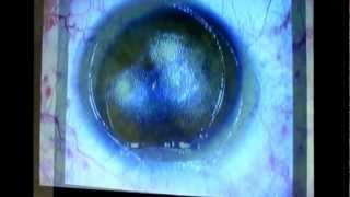 Montpellier Presbytie opération par Laser Lasik Méthode LBV  Dr Coullet [upl. by Eixam]