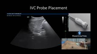 Acute Heart Failure Ultrasound [upl. by Dralliw647]