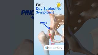 Femoroacetabular impingement FAI What Are The Key Subjective Symptoms physio physicaltherapy [upl. by Lustig228]