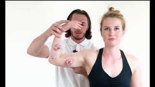 Myofascial Cupping  median nerve [upl. by Ellesirg]