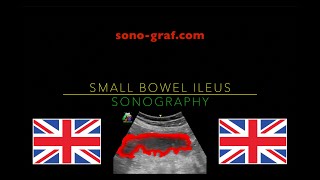 Sonography  Small Bowel Ileus [upl. by An]