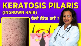 Keratosis Pilaris Treatment  Ingrown Hair on Arms Legs Face Buttocks  Home Remedies in Hindi [upl. by Naginarb]