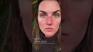 Osmosis Results  Blemish Prone Skin [upl. by Bowne437]