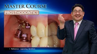 Master Course  PROSTHODONTICS Diagnosis amp treatment plan for posterior implant [upl. by Adnoryt301]