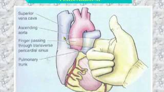 34 Transverse sinus of pericardium [upl. by Badr]