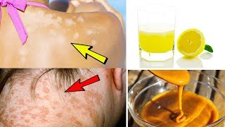 5 Effective Home Remedies For Treating Tinea Versicolor – Home Treatment Of Tinea Versicolor [upl. by Fridlund]