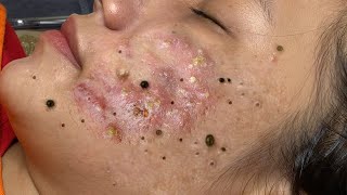 Big Cystic Acne Blackheads Extraction Blackheads amp Milia Whiteheads Removal Pimple Popping  1472 [upl. by Veron]