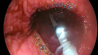 Dilatation œsophagienne pour achalasie [upl. by Fisken]