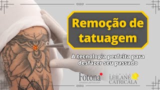 Remoção de tatuagem com o LASER FOTONA STARWALKER [upl. by Finnie]