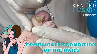 Nail Fungus Care κεντροποδιου kentropodiou footcare podologos podiatrist corn podiatry [upl. by Lipfert197]