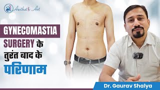 Gynecomastia Surgery के तुरंत बाद के परिणाम  Gynecomastia Results after 3 Days  Dr Gaurav Shalya [upl. by Elden397]