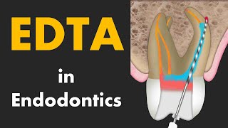 EDTA in Root Canal Treatment [upl. by Vasti20]