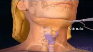 lipoaspiração da papada  cirurgia plástica vidoes antes e depois Fortaleza [upl. by Willyt244]